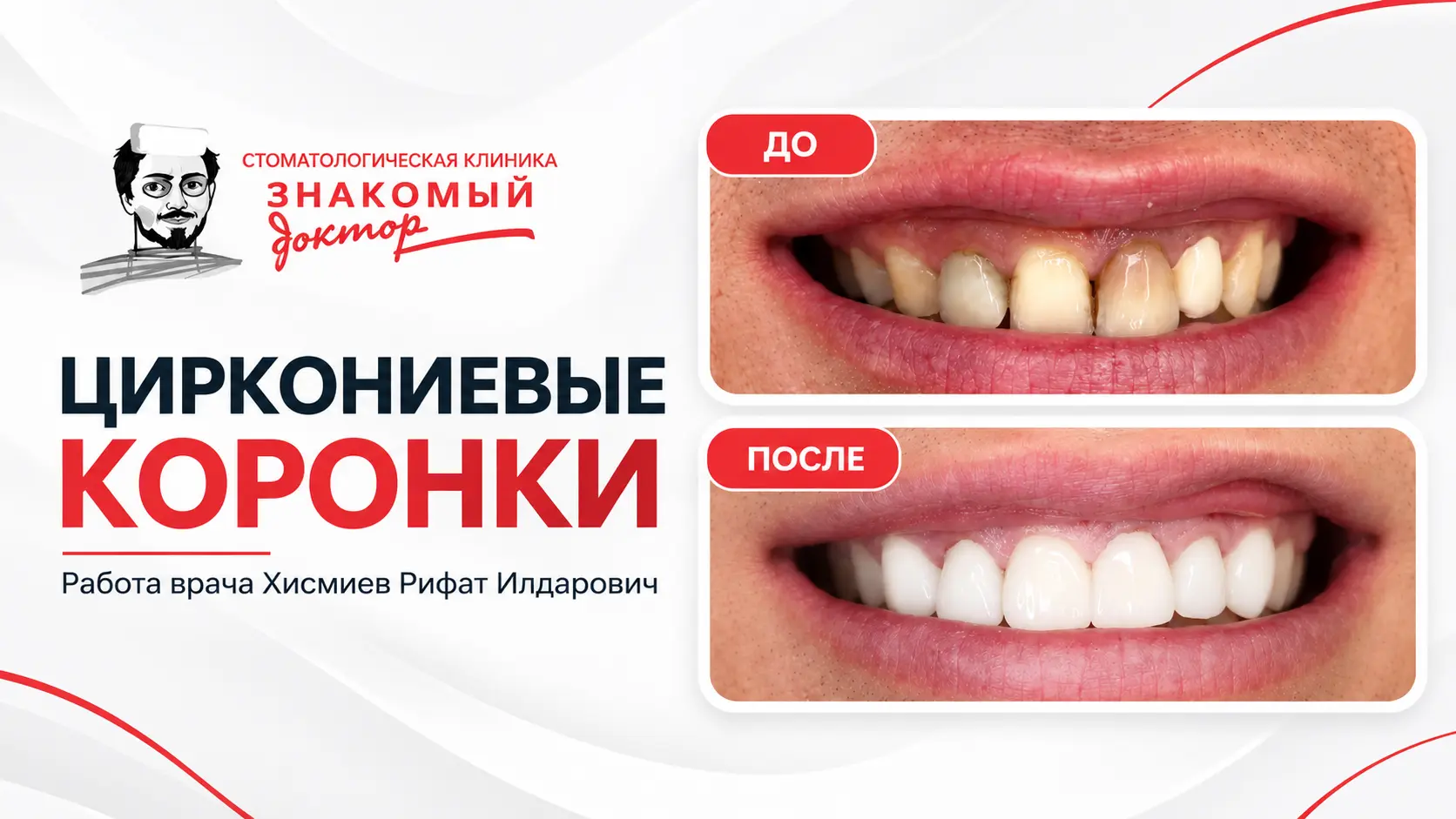 Кейс циркониевых коронок_ до и после