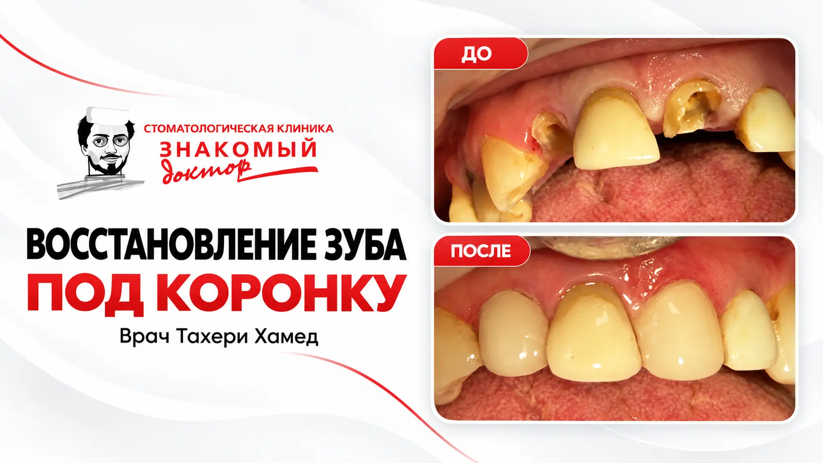 Восстановление зуба под коронку_ до и после